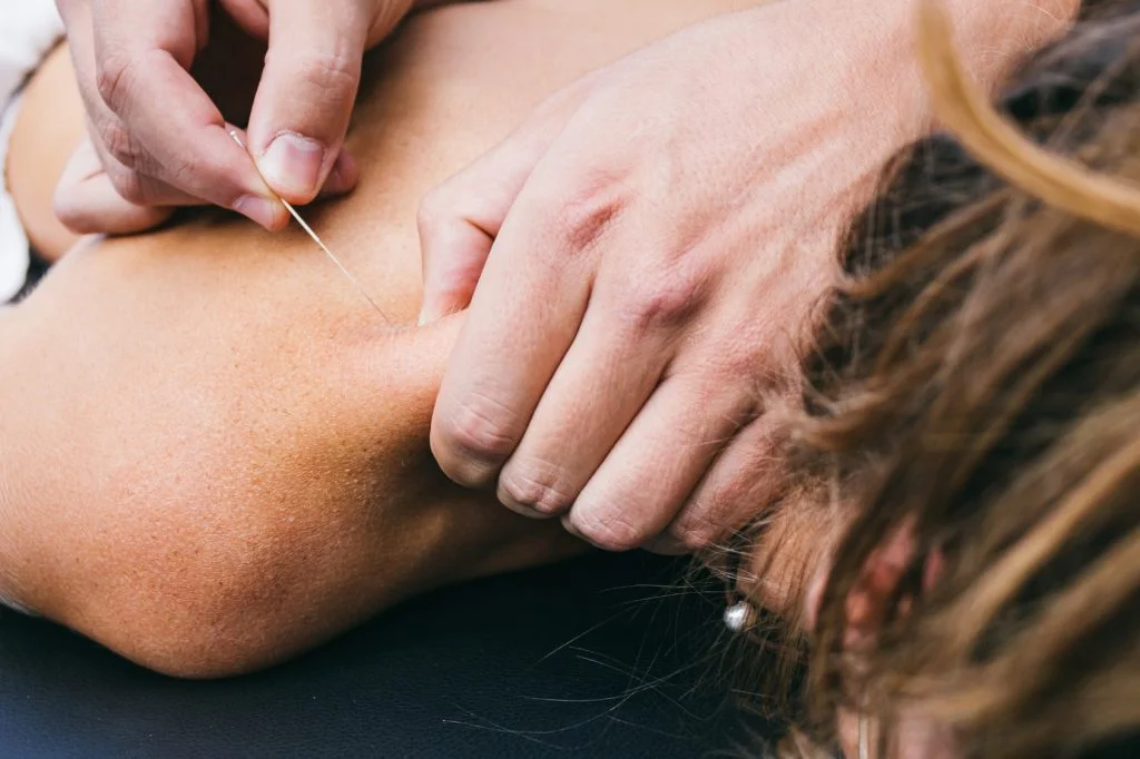 A woman receiving trigger point therapy on her back through acupuncture.