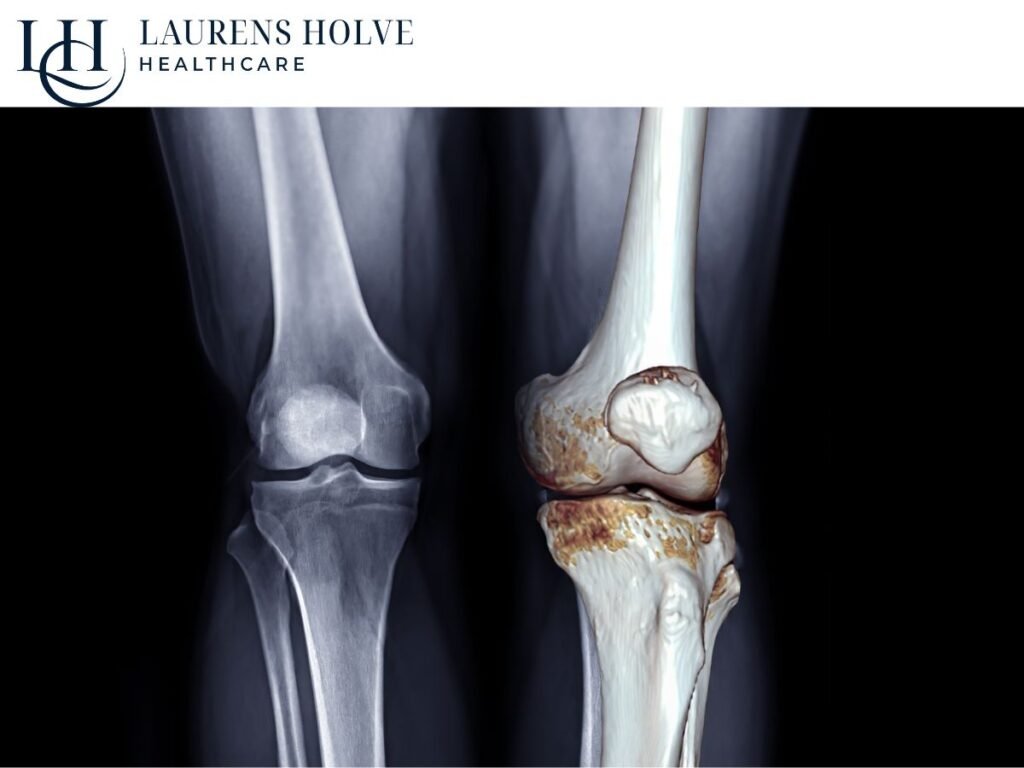 Understanding Osteoarthritis