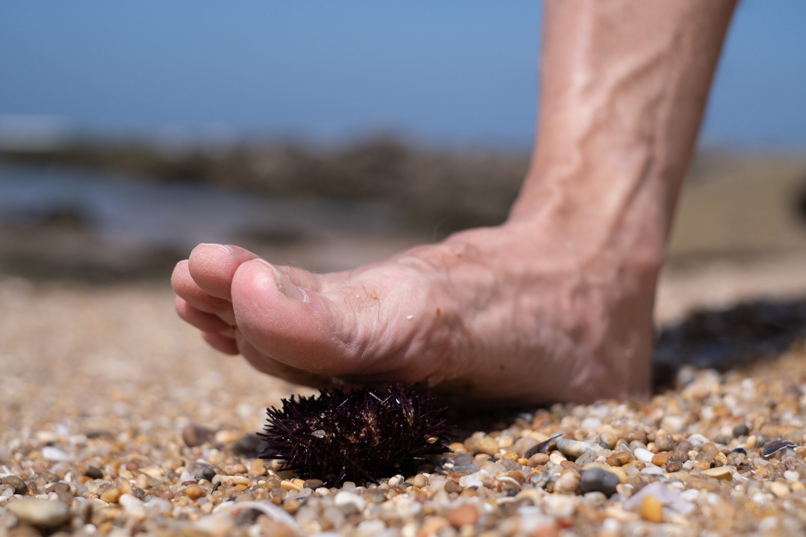 Forefoot Pain